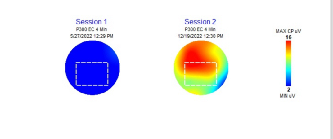 Pre and post Alpha Imprinting P300 brain scans — Sports concussion disorder to Healthy activation